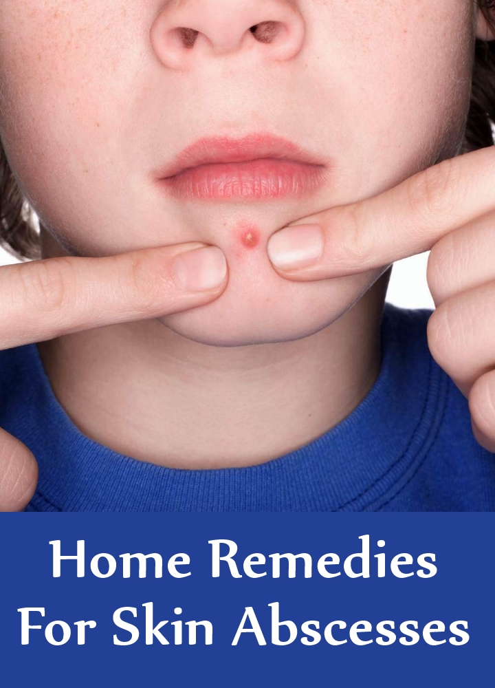 6 Home Remedies For Skin Abscesses