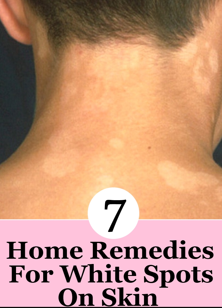 7 Home Remedies For White Spots On Skin Search Home Remedy