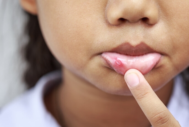 Canker Sores Canker Sores