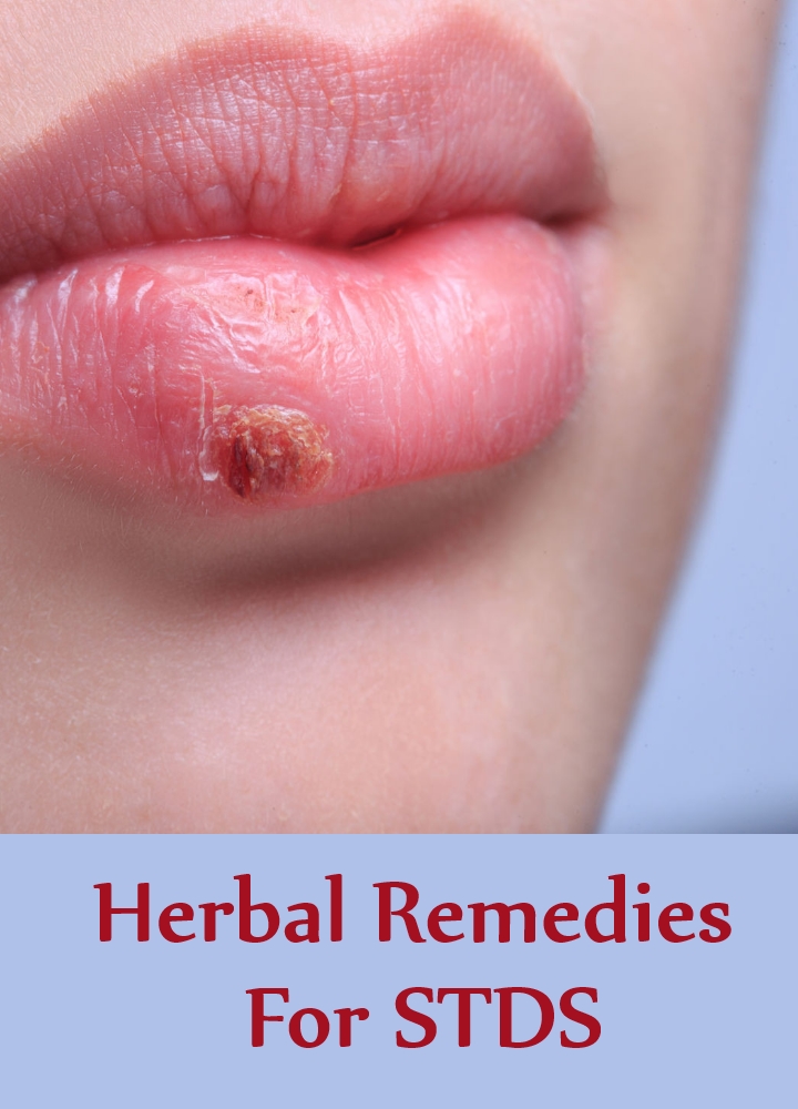 Herbal Remedies For STDS