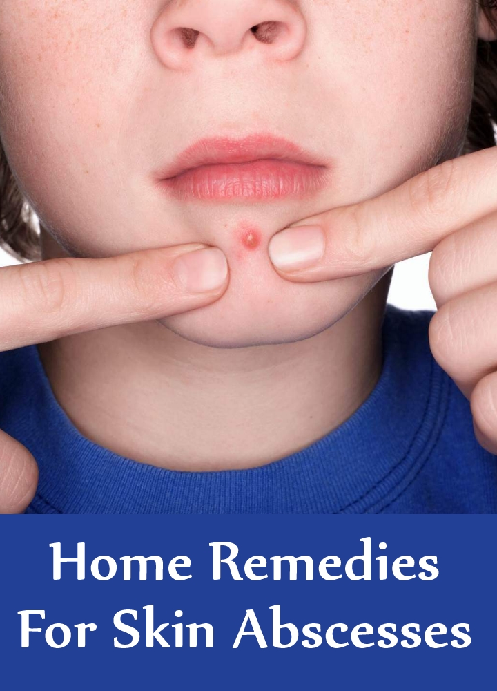 6 Home Remedies For Skin Abscesses Search Home Remedy