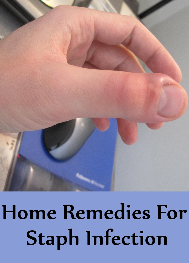 Home Remedies For Staph Infection