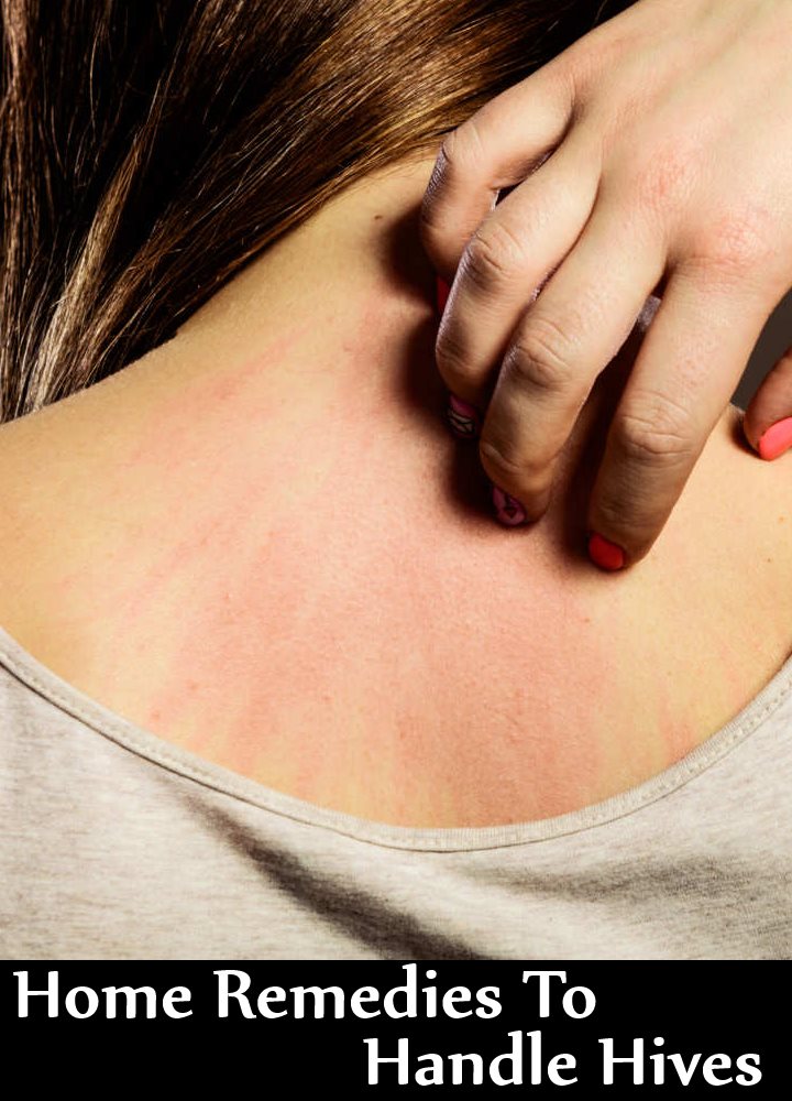 7 Home Remedies To Handle Hives