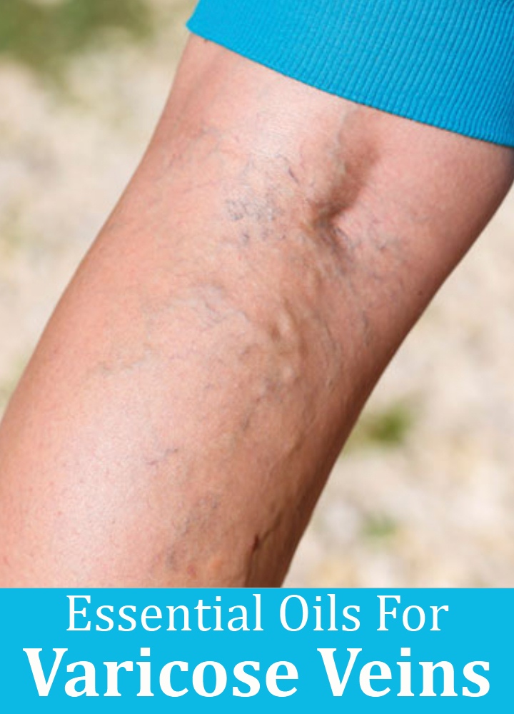 Oils For Varicose Veins