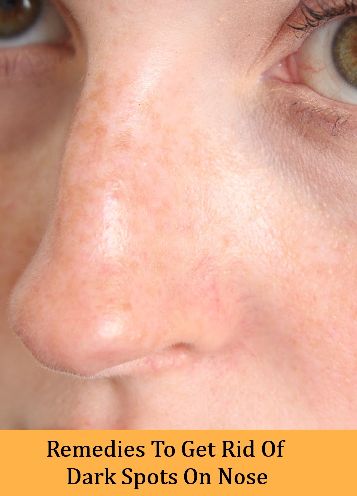 Remedies To Get Rid Of Dark Spots On Nose